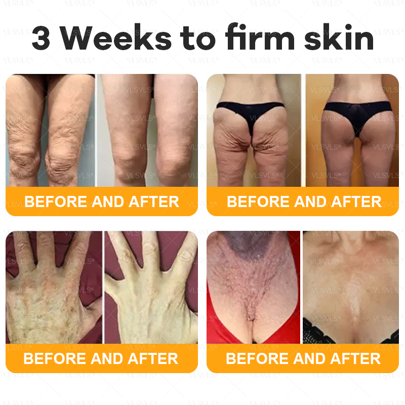 Made and Shipped from USA ✨ VLSVLS® Bee Venom Skin Restoration Cream with Collagen & Matrixyl 3000 | Obesity🔥 Sagging Skin, Fine Lines, Loss of Firmness, Flat Bust, Drooping Hips, and More🔥 LAST DAY 80% OFF 🗽