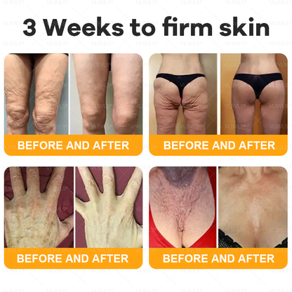 Made and Shipped from USA ✨ VLSVLS® Bee Venom Skin Restoration Cream with Collagen & Matrixyl 3000 | Obesity🔥 Sagging Skin, Fine Lines, Loss of Firmness, Flat Bust, Drooping Hips, and More🔥 LAST DAY 80% OFF 🗽