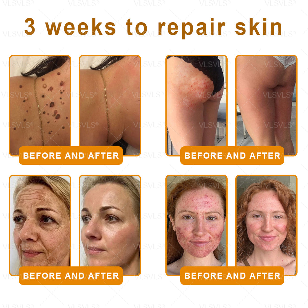 Made and Shipped from USA ✨ VLSVLS® Bee Venom Skin Restoration Cream with Collagen & Matrixyl 3000 | Obesity🔥 Sagging Skin, Fine Lines, Loss of Firmness, Flat Bust, Drooping Hips, and More🔥 LAST DAY 80% OFF 🗽